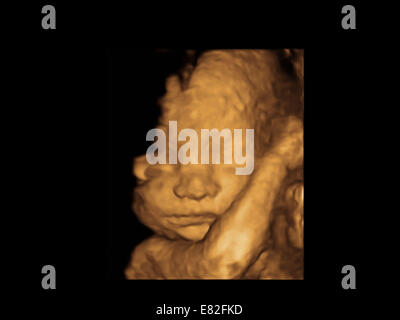 Le visage de foetus, de couleur 3-D échographie d'un fœtus, l'âge gestationnel : 24 semaines. Banque D'Images