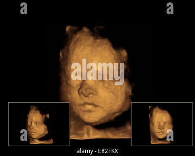 Le visage de foetus, de couleur 3-D échographie d'un fœtus, l'âge gestationnel : 28 semaines. Banque D'Images