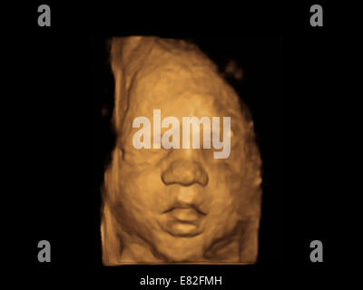 Le visage de foetus, de couleur 3-D échographie d'un fœtus, l'âge gestationnel : 31 semaines et 4 jours. Banque D'Images