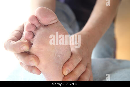 Un homme vérifie le sec, une desquamation de la peau de son pied d'athlètes champignon entre ses orteils. Banque D'Images