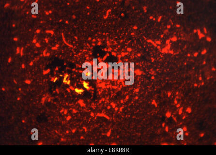 Cet acide fluorescent-fast (vitraux Smithwick) photomicrographie a révélé la présence de la bactérie Mycobacterium tuberculosis dans Banque D'Images