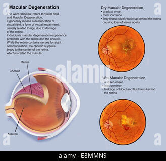Avec la dégénérescence maculaire de la rétine. Banque D'Images
