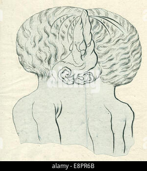 Date : ca. 1820-1840 : Description de l'image fusionnée des jumeaux à la tête et le thorax. Trésor caché de la NLM p. 98 resource.nlm.nih.go Banque D'Images