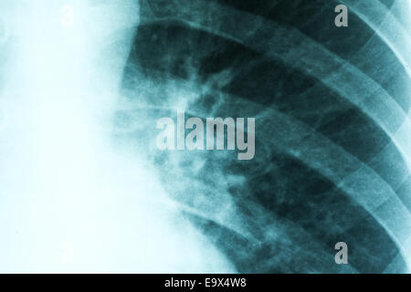 Medical X-Ray de pneumonie poumons infectés Banque D'Images