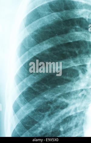 Medical X-Ray de pneumonie poumons infectés Banque D'Images