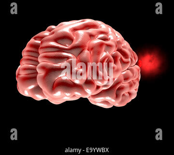 L'élargissement du cerveau avec anévrisme cérébral Banque D'Images