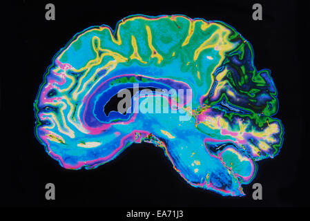 L'image IRM Cerveau sur fond noir Banque D'Images