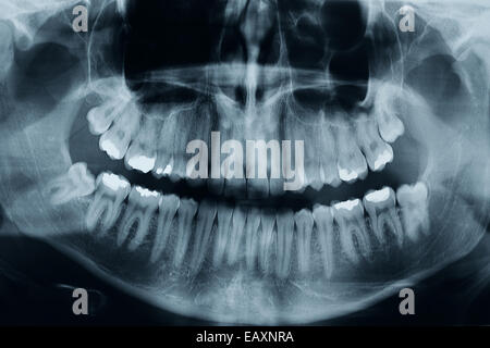 Montre 3 rx dentaire dents de sagesse. il y a un critique dans la partie inférieure de l'image, c'est d'une haute résolution, photo Banque D'Images