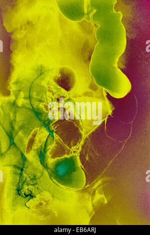 Le CANCER DU CÔLON, X-RAY Banque D'Images