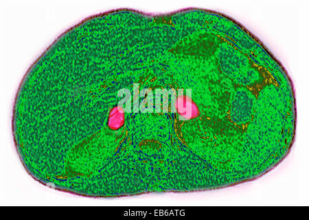 Les glandes surrénales, le CT scan Banque D'Images