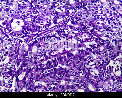 Carcinome gastrique, microscopique, section 400 x Banque D'Images