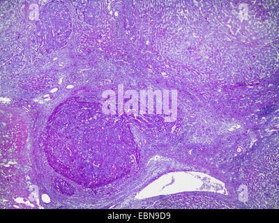 Cancer du foie primaire, microscopique, section 40 x Banque D'Images