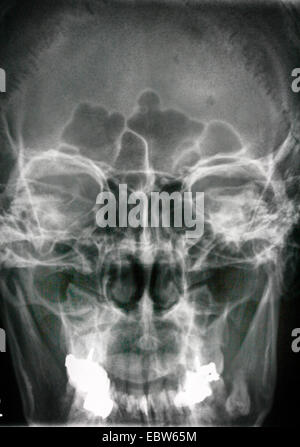 Les gens, les êtres humains, les humains (Homo sapiens sapiens), X-ray de la tête humaine Banque D'Images