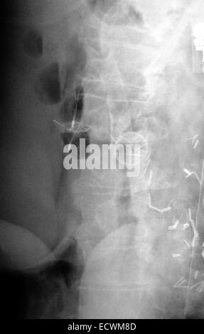 Abdomen x-ray montrant un caillot de sang dans la veine cave filtre. Banque D'Images