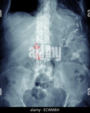 Abdomen x-ray montrant un caillot de sang dans la veine cave filtre. Banque D'Images