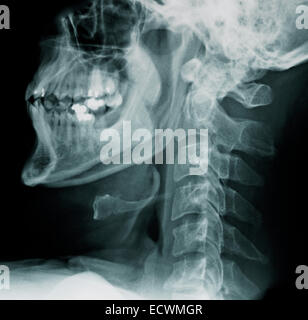 Colonne cervicale normale x-rays. Banque D'Images