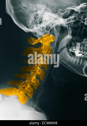 Colonne cervicale normale x-rays. Banque D'Images