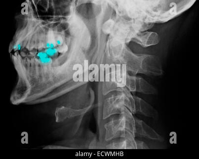 Colonne cervicale normale x-rays. Banque D'Images