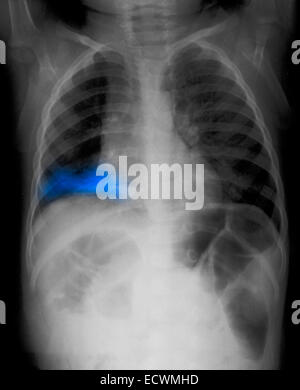 Radiographie montrant une pneumonie du lobe inférieur droit. Banque D'Images