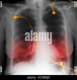 CXR montrant la MPOC, la maladie pulmonaire obstructive chronique. Banque D'Images