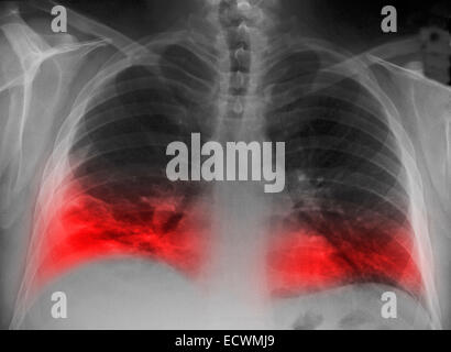 Radiographie montrant un infiltrat pulmonaire d'une pneumonie. Banque D'Images