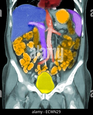 Les reconstructions coronale d'une tomodensitométrie de l'abdomen montrant cancer métastatique de la prostate. Banque D'Images