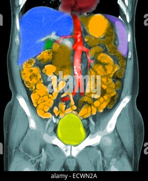 Les reconstructions coronale d'une tomodensitométrie de l'abdomen montrant cancer métastatique de la prostate. Banque D'Images