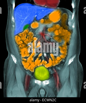 Les reconstructions coronale d'une tomodensitométrie de l'abdomen montrant cancer métastatique de la prostate. Banque D'Images