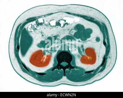 Scanographie de l'abdomen montrant un petit calcul rénal. Banque D'Images