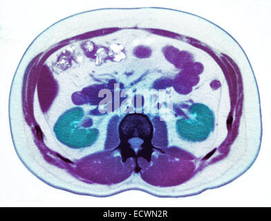 Scanographie de l'abdomen montrant un petit calcul rénal. Banque D'Images