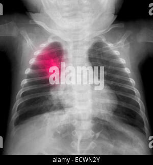 Radiographie d'un garçon de 3 mois présentant une pneumonie. Banque D'Images