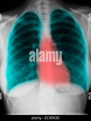 La radiographie du thorax normale d'une femme de 24 ans. Banque D'Images