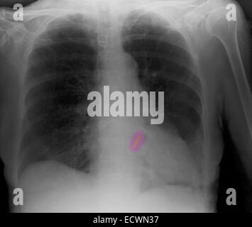 Radiographie montrant une valve cardiaque de remplacement. Banque D'Images