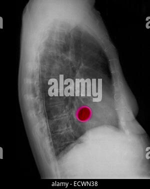 Radiographie montrant une valve cardiaque de remplacement. Banque D'Images