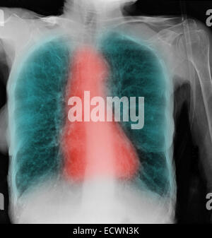 Radiographie montrant une bronchopneumopathie chronique obstructive. Banque D'Images