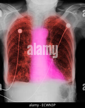 Radiographie montrant une bronchopneumopathie chronique obstructive. Banque D'Images