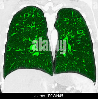 La fibrose kystique CT scan vue coronale. Banque D'Images