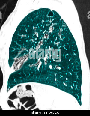 La fibrose kystique CT scan vue sagittale. Banque D'Images