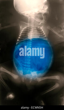 X-ray montrant une grande quantité de gaz dans l'abdomen. Banque D'Images