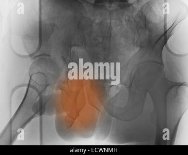 X-ray of a 30 year old man avec une fracture du bassin. Banque D'Images