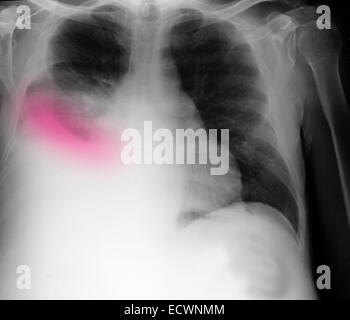 Radiographie montrant une cirrhose et d'un épanchement pleural. Banque D'Images