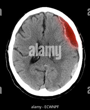 CT scan de la tête montrant un hématome sous. Banque D'Images