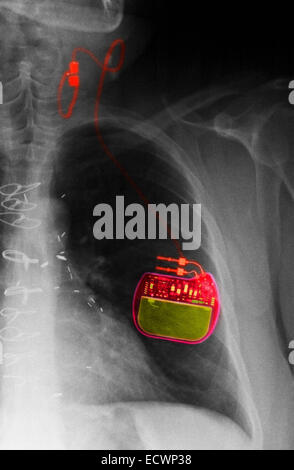 Radiographie montrant un stimulateur du nerf pour l'épilepsie. Banque D'Images
