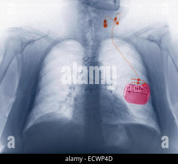 Radiographie montrant un stimulateur du nerf pour l'épilepsie. Banque D'Images