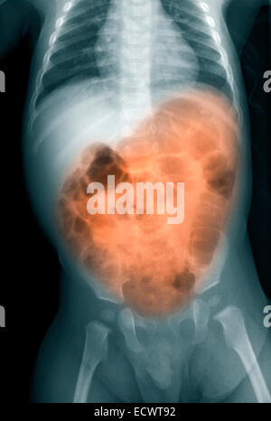 Radiographie d'un garçon de 7 mois avec des vomissements et diarrhée. Banque D'Images