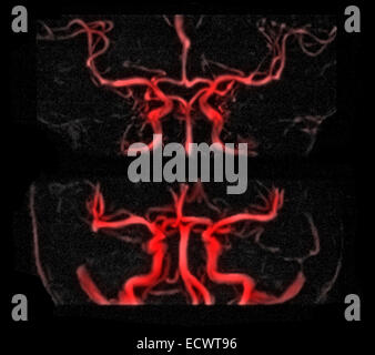 L'IRM cérébrale vasculaire étude radiographique. Banque D'Images