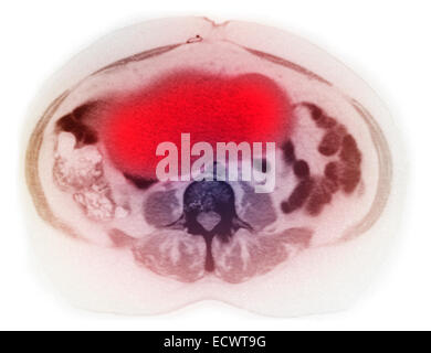 Le cancer de l'ovaire sur CT scan. Banque D'Images