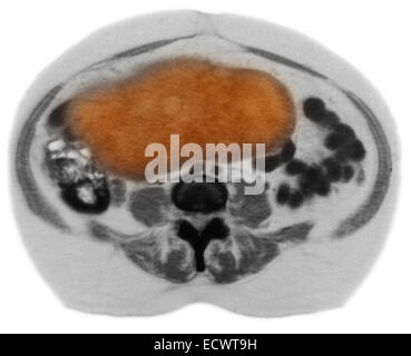 Le cancer de l'ovaire sur CT scan. Banque D'Images
