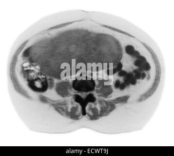 Le cancer de l'ovaire sur CT scan. Banque D'Images