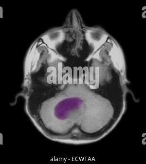 Pilocytic astrocytome du cerveau comme vu sur irm. Banque D'Images